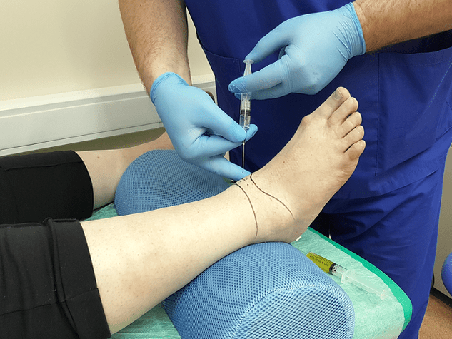 puncture for ankle arthrosis