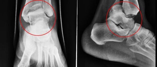 radiograph for ankle arthrosis