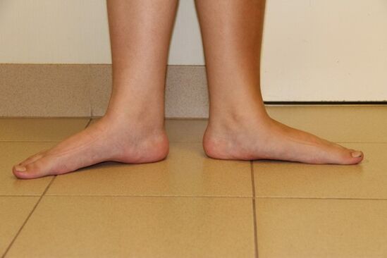Cervical arthrosis is sometimes caused by a flat leg