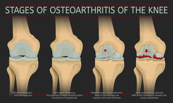 development of joint arthrosis