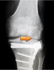arthrosis of the knee joint