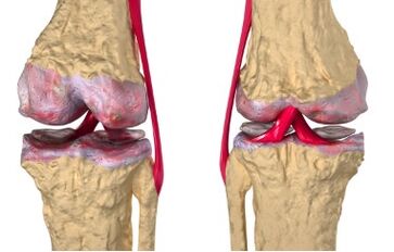 Varicose veins are the cause of gonarthrosis