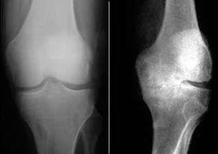 The method of diagnosis of osteoarthritis of the