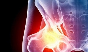 causes of hip arthrosis
