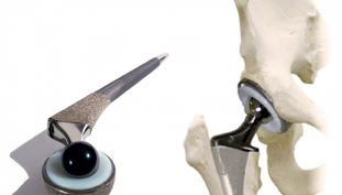 hip joint surgery for arthrosis