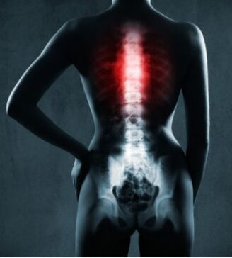 The affected area of ​​the spine is chest osteochondrosis